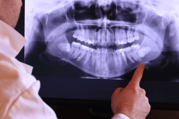 Best Emergency Treatment for Dental Infections or Abscesses in Cutler, CA
